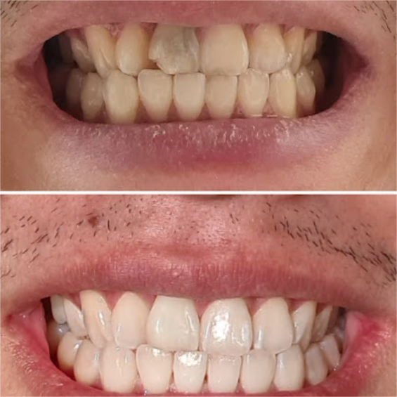 Cosmetic Dentistry - Beautiful Smile Transformations at Dr Christina's Dental Clinic